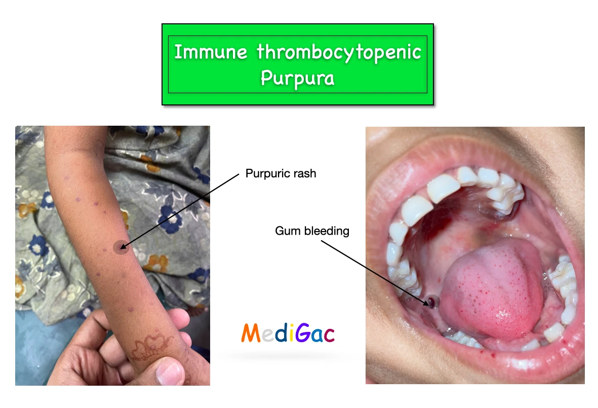 Immune thrombocytopenic purpura